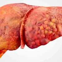 بهبودکبد چرب