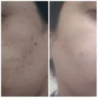 سرم گیاهی ضدجوش و لک|آرایشی، بهداشتی، درمانی|سلماس, |دیوار