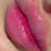 ژل،بوتاکس،مزوتراپی،مزونیدلینگ|خدمات آرایشگری و زیبایی|دوگنبدان, |دیوار