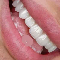 کامپوزیت دندانپزشکی روکش تهرانسر سعادت آباد صادقیه