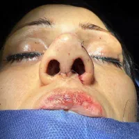 رینوپلاستی ۲۵میلیون|خدمات آرایشگری و زیبایی|قرچک, زیبا شهر|دیوار