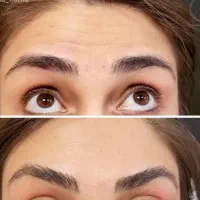 بوتاکس برای اقایان و خانم ها
