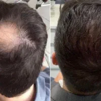 میکرواسکالپ خداحافظی با کم حجمی مو برای همیشه