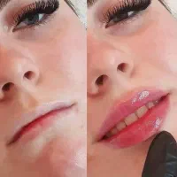 جذب مدل برای تزریق فیلر لب