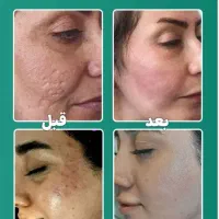 اولین مرکز لیزر با دو مدل دستگاه لیزر شاتی و رولی|خدمات آرایشگری و زیبایی|نجف‌آباد, باغ ملی|دیوار