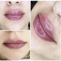 ۲۰ درصد تخفیف خدمات ژل و بوتاکس