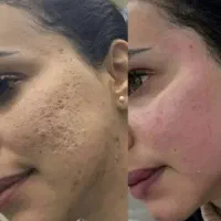 درمان تخصصی اسکار صورت