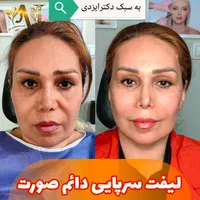 فیلر بادی، جراحی سرپایی زیبایی حجم دهی صورت بدن