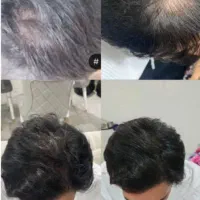 روند قطعی ریزش مو