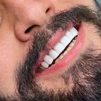 کامپوزیت دندان /طرح لبخند( اقساط)|خدمات آرایشگری و زیبایی|مشهد, راهنمایی|دیوار