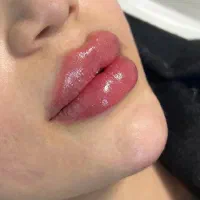 مدل فیلر بوتاکس