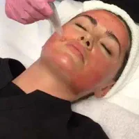 مزونیدلینگ ۱۱۰۰فشیال۵۵۰ الکترولیزخال لاغری پلاژن