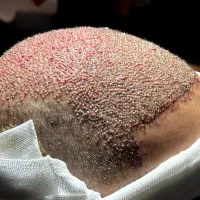 آموزش کاشت مو