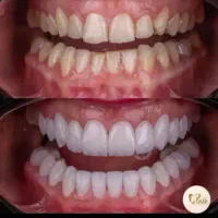 دندانپزشکی و زیبایی بدون پیش پرداخت|خدمات آرایشگری و زیبایی|قم, نوقطار|دیوار