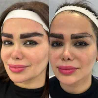 کاشت ابرو با متد جدید