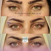 برداشتن پف بالا و پایین چشم متداروپایی|خدمات آرایشگری و زیبایی|اصفهان, جلفا|دیوار