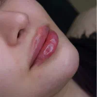 خدمات زیبایی تزریق فیلر ،بوتاکس و لیزر در مطب پزشک|خدمات آرایشگری و زیبایی|قم, نیروگاه|دیوار