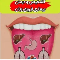 درمانه بیماری بصورت ریشه ایی