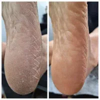 کفسابی پدیکور و رفع تیرگی تخفیف ب مدت ۲ روز|خدمات آرایشگری و زیبایی|فولادشهر, B2|دیوار