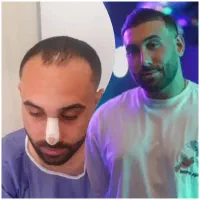 روش جدید بدون جراحی فول تراکم