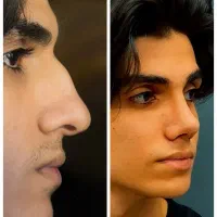 بزگترین هدیه عمل بینی در شیراز 100+میلیون|خدمات آرایشگری و زیبایی|شیراز, ستارخان|دیوار