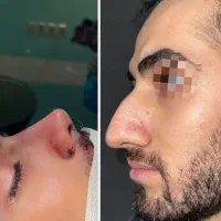 عمل بینی/بلفاروپلاستی/غبغب/کاشت ابرو/اقساط