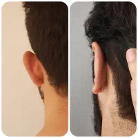 جشنواره جراحی زیبایی گوش/اتوپلاستی/گوش برجسته|خدمات زیبایی و سلامت|تهران, آرژانتین|دیوار