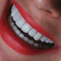 دندانپزشکی ، ایمپلنت، روکش، کامپوزیت ، عصب کشی