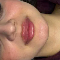 تزریق ژل و بوتاکس در کلینیک|خدمات آرایشگری و زیبایی|نسیم‌شهر, |دیوار