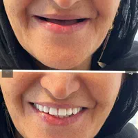 دندان مصنوعی بدون سقف*فلکسیبل*جایگزین ایمپلنت