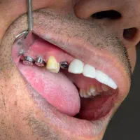 ایمپلنت دیجیتال اقساطی بدون سود تحت بیهوشی|خدمات آرایشگری و زیبایی|مرودشت, ژیان|دیوار