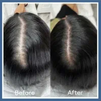 درمان ریزش با اسکراب اسکالپ