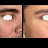رفع جای جوش ،ریزش مو ،خال برداری برای آقایان|خدمات آرایشگری و زیبایی|خرمشهر, |دیوار