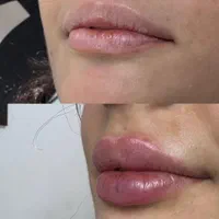 فیلر بوتاکس  کاشت مو و ابرو و...