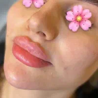 ژل لب،گونه،چانه،زاویه،شقیقه وبوتاکس باقیمتی عاالی