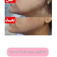 هایفو صورت۹۹۹هزارتومان|خدمات آرایشگری و زیبایی|اهواز, اهواز|دیوار