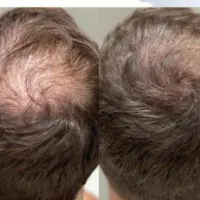 جشنواره prp و مزوتراپی ( آقایان و بانوان)|خدمات آرایشگری و زیبایی|بروجرد, |دیوار