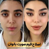 فیلربوتاکس گازی انزیم هیر نوا هایفوبیکینی