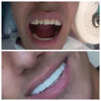 کامپوزیت دندان با بهترین کفیت با قیمتی مناسب|خدمات آرایشگری و زیبایی|یاسوج, |دیوار