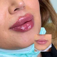 تکنسین ژل و بوتاکس و زیبایی خانم ها و آقایان|خدمات آرایشگری و زیبایی|اهواز, کوی فرهنگیان ۲|دیوار