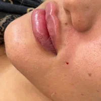جشنواره تزریق ژل بوتاکس(قیمت پایین کیفیت بالا)|خدمات آرایشگری و زیبایی|اصفهان, جلفا|دیوار