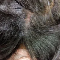 رفع شپش و رشک به صورت محرمانه در یک جلسه