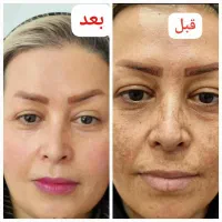 پک ضدلک
