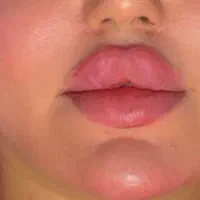 ژل و بوتاکس