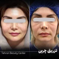 لیزیک چشم /لیپوماتیک /آبدومینو/ کاشت مو/بلفارو|خدمات آرایشگری و زیبایی|کرمانشاه, |دیوار