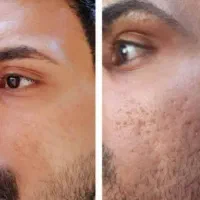 رفع مشکلات پوستی با بیوممتیک