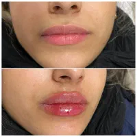 جشنواره کلینیک ژل و بوتاکس|خدمات آرایشگری و زیبایی|اصفهان, رزمندگان|دیوار