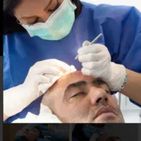 کاشت مو ابرو ریش وسیبیل