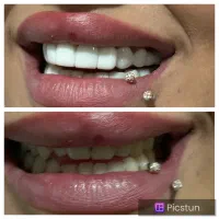 کامپوزیت متحرک دندان فوری