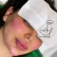 ساکشن چربی ،تزریق چربی ، تزریق ژل ،فیلر لب بلفارو|خدمات آرایشگری و زیبایی|خرم‌آباد, |دیوار